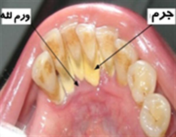 جرم دندان و راه مقابله با آن